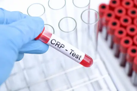 CRP Nedir? Yüksekliği ne anlama gelir?