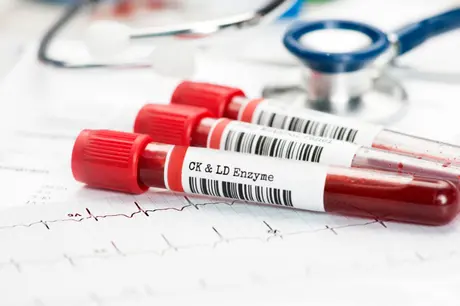 Kreatinin Kinaz Testi Nedir?